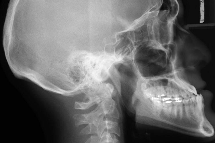 imported-xray-g318c83bb4_1920-81f5b4.jpg