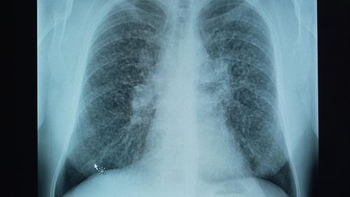 imported-skynews-silicosis-kitchens_7244384.jpg