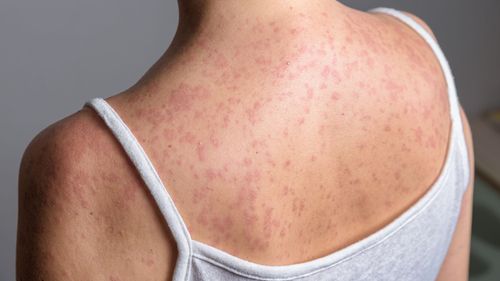 imported-skynews-measles-spots-rash_7165384.jpg