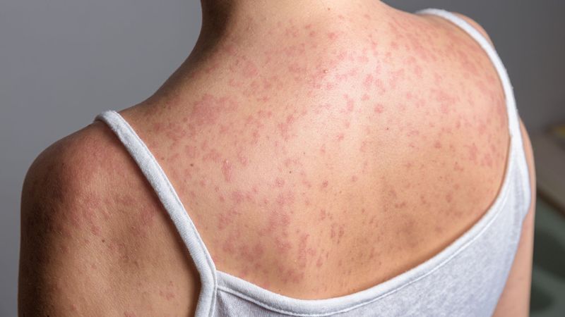 imported-skynews-measles-spots-rash_7165384.jpg