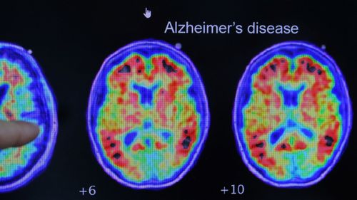 imported-skynews-alzheimers-disease_6725040.jpg