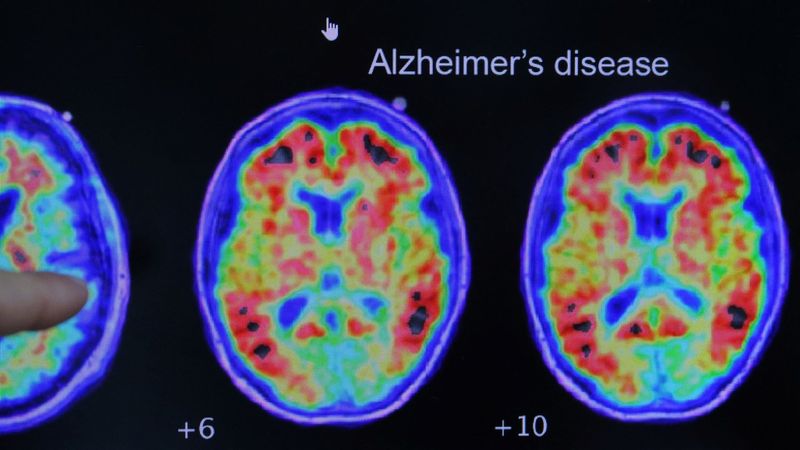 imported-skynews-alzheimers-disease_6725040.jpg