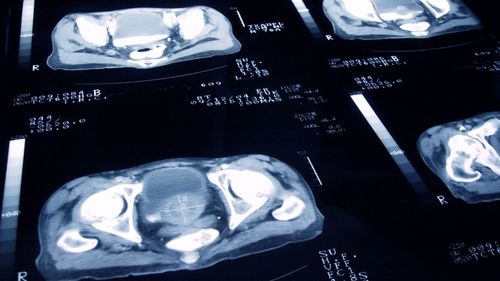 imported-skynews-prostate-cancer_7176769.jpg
