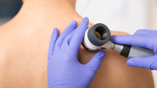 imported-skynews-skin-cancer-melanoma_7255352.jpg